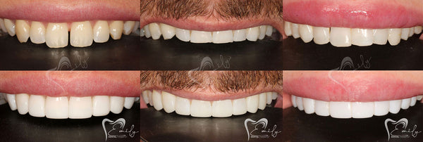 Mini Smile Makeovers
